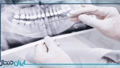 رادیوگرافی دندان چیست و نحوه انجام چگونه است؟