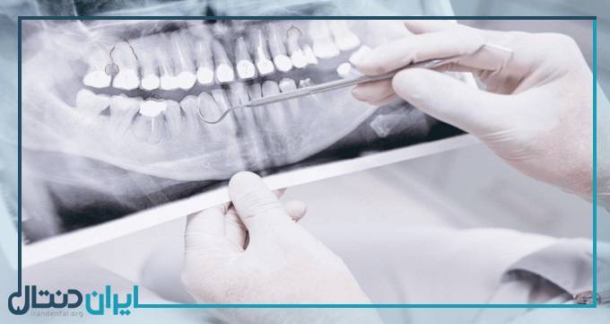 رادیوگرافی دندان چیست و نحوه انجام چگونه است؟