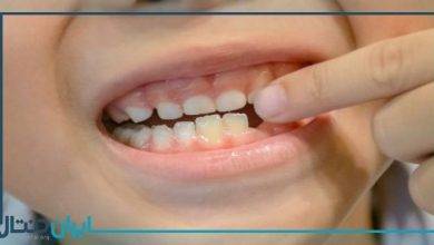 دندان‌ های شیری بی‌ اهمیت نیستند!