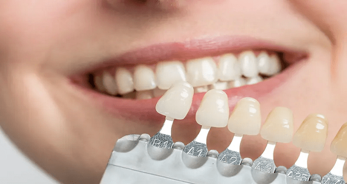 روش های لمینت دندان