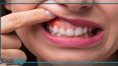 آیا بیماری لثه با فشار خون ارتباط دارد؟