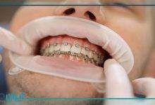 اقدامات قبل از سیم کشی دندان