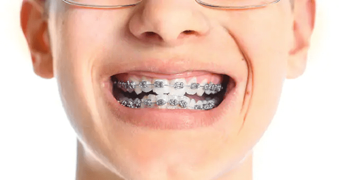سیم کشی دندان چیست و چگونه انجام می شود؟