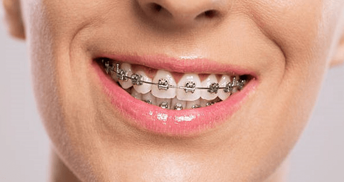 آیا ارتودنسی دندان درد دارد؟