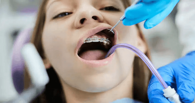 ارتودنسی دندان چقدر طول می کشد؟