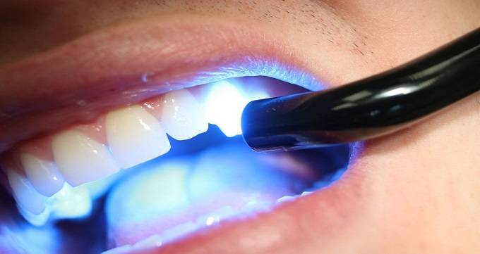 بریج دندان چیست و چه عوارضی دارد؟