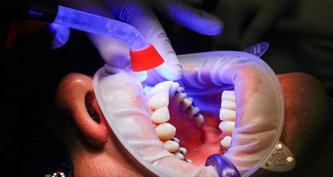 کامپوزیت دندان چیست؟