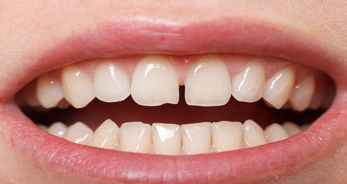 لمینت دندان چیست و برای چه کسانی مناسب است؟