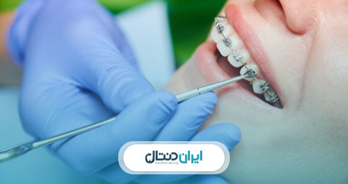 انواع ارتودنسی برای کودکان و بزرگسالان