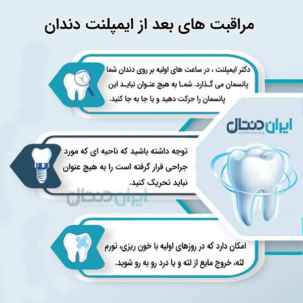 ایمپلنت چیست؟