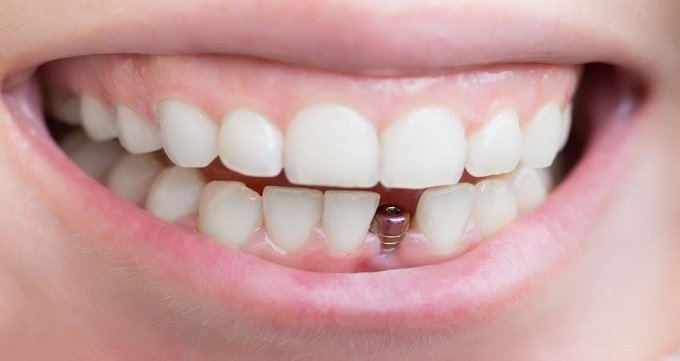 ایمپلنت دندان یعنی چه؟