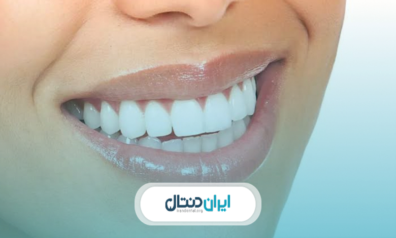 کامپوزیت زودتر تغییر رنگ می دهد یا لمینت؟