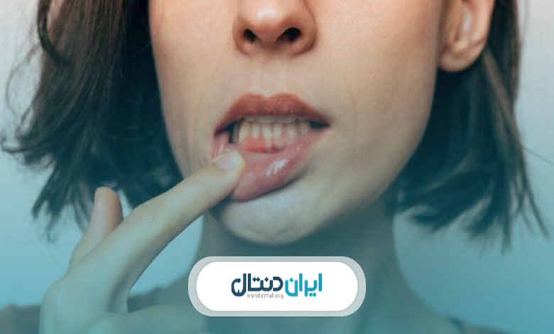 چگونه از تحلیل لثه جلوگیری کنیم؟