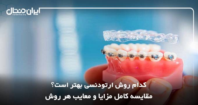 کدام روش ارتودنسی بهتر است؟