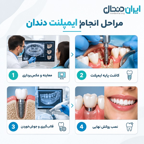 چگونه بهترین متخصص ایمپلنت در اردبیل را انتخاب کنیم؟