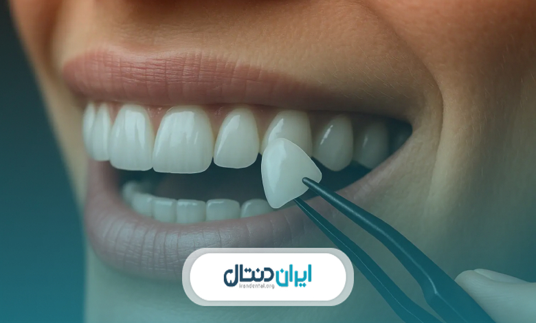 معیارهای انتخاب بهترین متخصص لمینت در فرشته