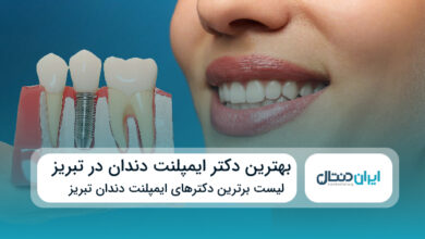 بهترین دکتر ایمپلنت دندان در تبریز
