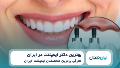 بهترین دکتر ایمپلنت در ایران