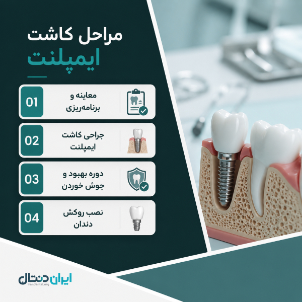 مراحل کاشت ایمپلنت دندان