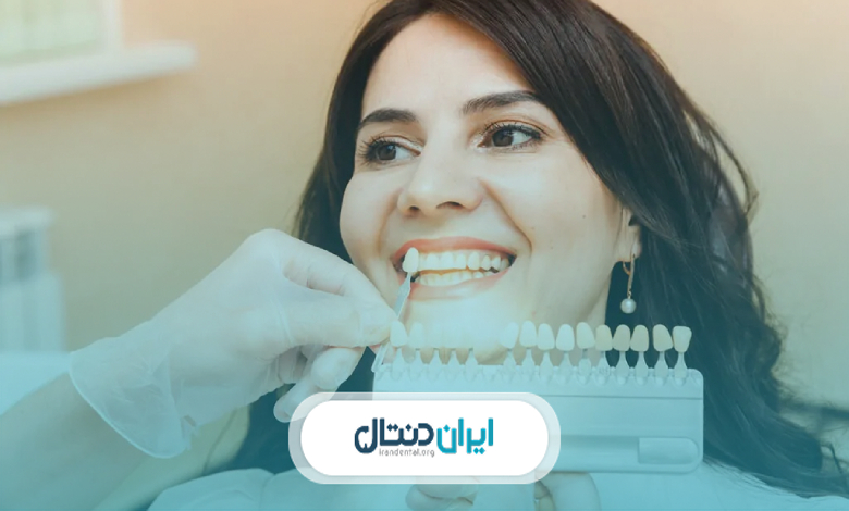 مراقبت های بعد از انجام کامپوزیت و لمینت