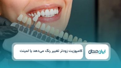 کامپوزیت زودتر تغییر رنگ می دهد یا لمینت؟