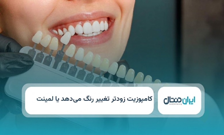 کامپوزیت زودتر تغییر رنگ می دهد یا لمینت؟