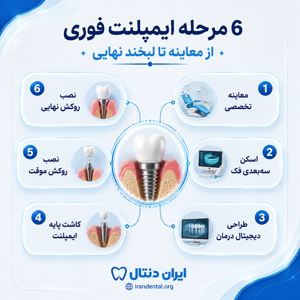 کاشت دندان فوری چگونه انجام میشود؟