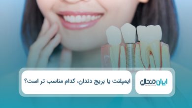 ایمپلنت یا بریج دندان کدام مناسب تر است؟