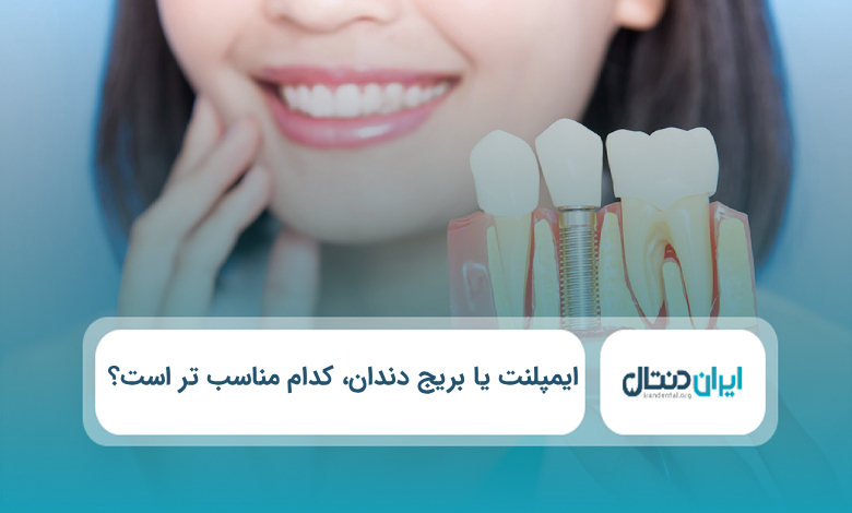 ایمپلنت یا بریج دندان کدام مناسب تر است؟
