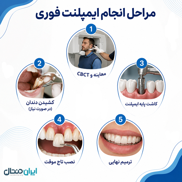 ایمپلنت فوری چیست و چه تفاوتی با ایمپلنت معمولی دارد؟