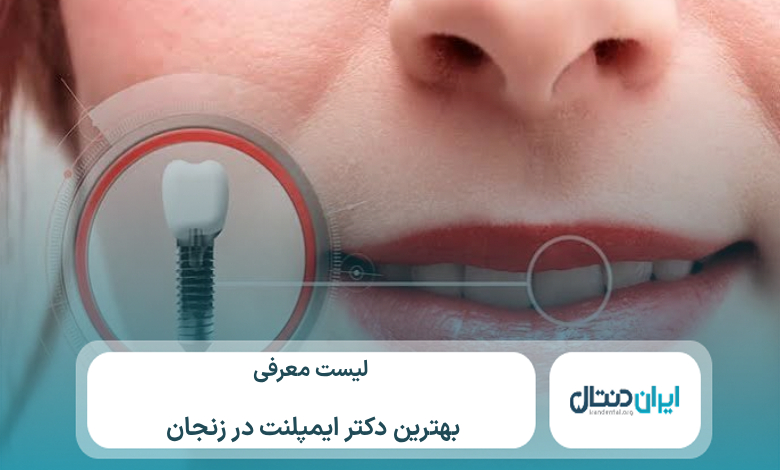معرفی 10 تا از بهترین دکتر ایمپلنت در زنجان ⚡【سال1405】💙