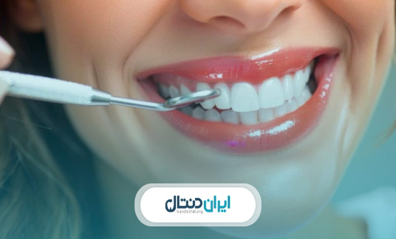 قبل از انجام لمینت چه هزینههایی باید در نظر بگیرید؟