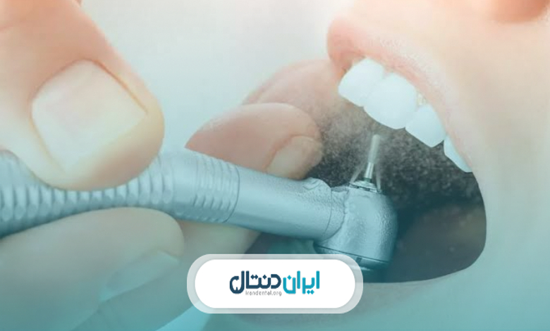 بهترین زمان برای انجام بروساژ دندان چه موقع است؟