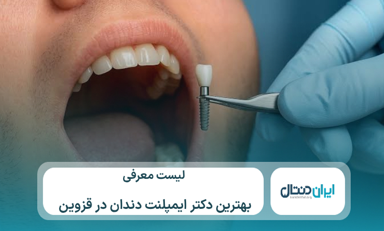 معرفی 10 تا از بهترین دکتر ایمپلنت در قزوین⚡【سال1405】💙