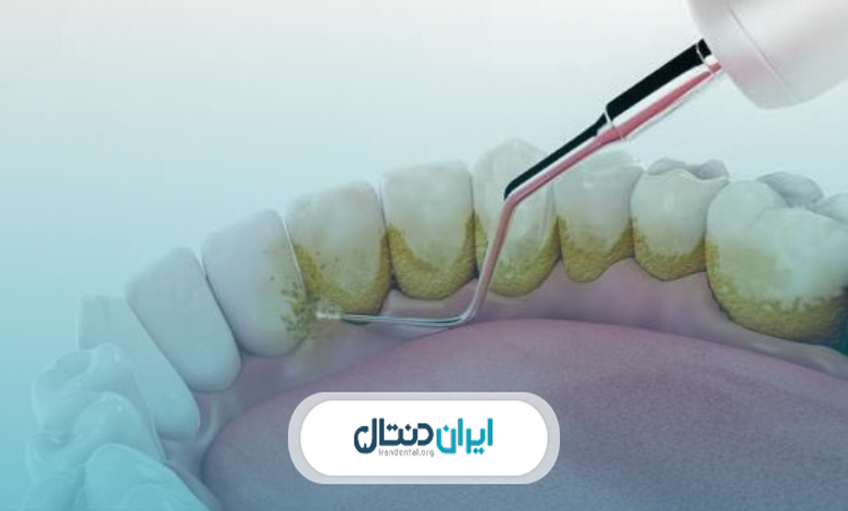 آیا جرمگیری دندان را سفید میکند؟