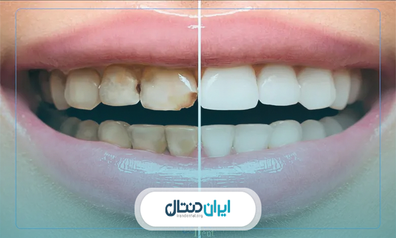 آیا جرم گیری دندان به مینای دندان آسیب میزند؟