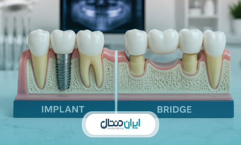 بریج دندان بهتر است یا ایمپلنت؟