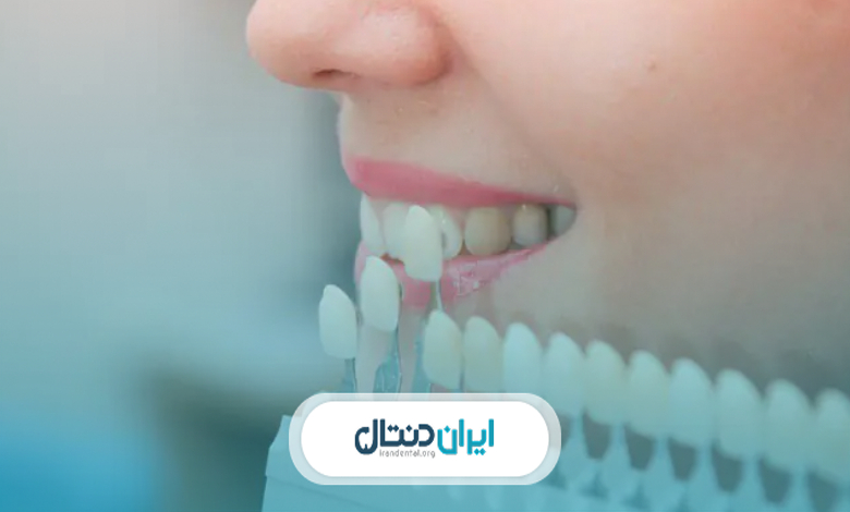 لمینت دندان بهتر است یا کامپوزیت دندان؟