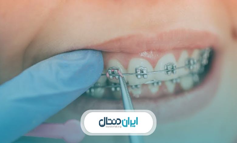 فرق ارتودنسی ثابت با متحرک چیست؟