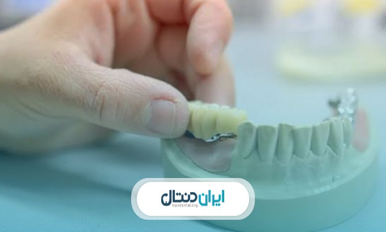 بریج دندان برای چه افرادی مناسب است؟