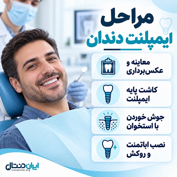مراحل ایمپلنت دندان