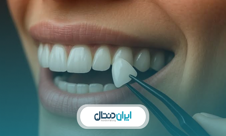 توصیه های مراقبتی از کامپوزیت دندان